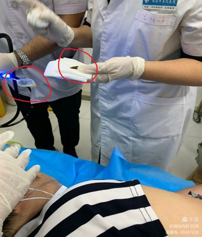 网篮在异物取出术中的应用