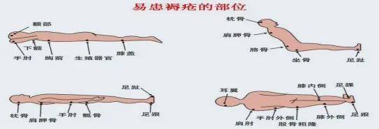 压疮的预防 压疮的预防