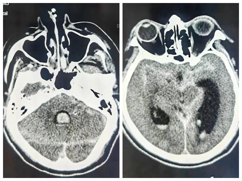 【典型病例】摔倒了可不一定就是外伤,小心“炸弹”来袭 【典型病例】摔倒了可不一定就是外伤,小心“炸弹”来袭