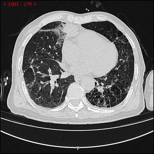 不开刀杀肿瘤：血管介入科开展首例CT引导下肺恶性肿瘤射频消融术