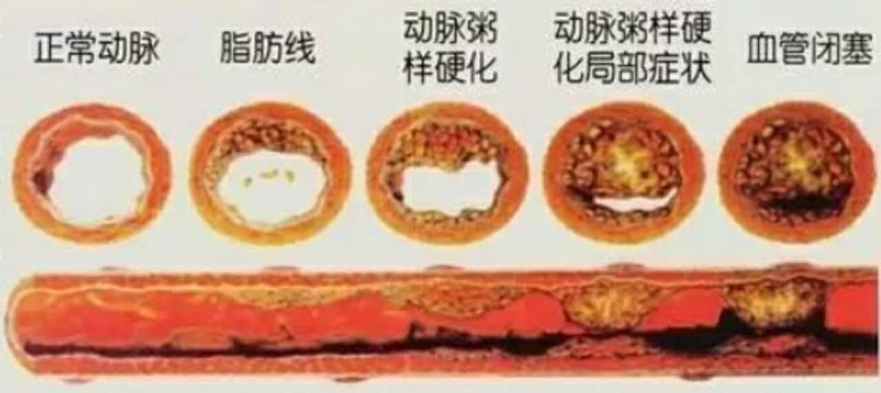体检发现颈动脉斑块怎么办?10个要点要掌握 体检发现颈动脉斑块怎么办?10个要点要掌握