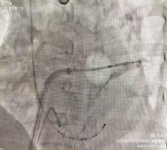 【特色技术】心血管病院——房颤冷冻消融+左心耳封堵“一站式”介入手术