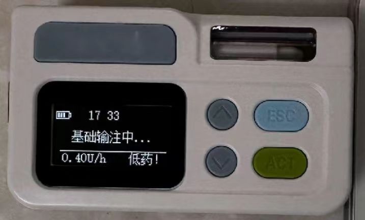远程胰岛素泵助力手术患者的血糖管理 远程胰岛素泵助力手术患者的血糖管理
