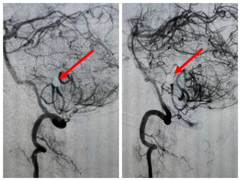【典型病例】摔倒了可不一定就是外伤,小心“炸弹”来袭 【典型病例】摔倒了可不一定就是外伤,小心“炸弹”来袭