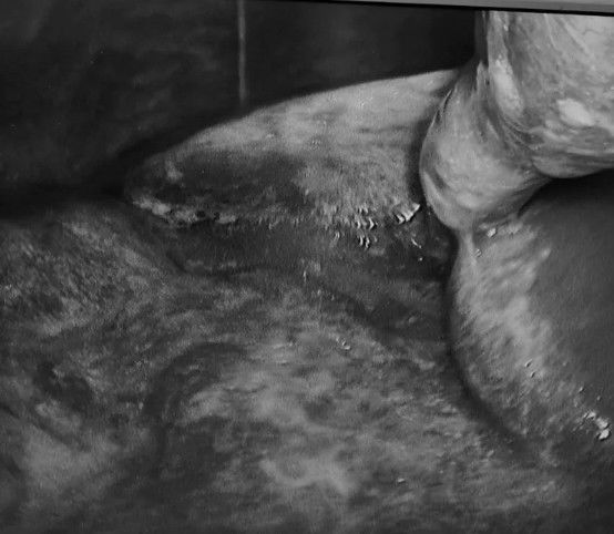 联合腔镜救治外伤后肠破裂患者