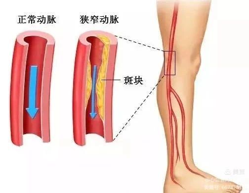 【健康科普】当出现这些症状时,就要警惕血管堵塞 【健康科普】当出现这些症状时,就要警惕血管堵塞