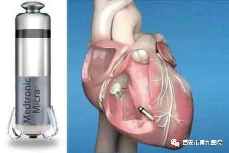 【科普速递】心脏起搏器~为生命续航 【科普速递】心脏起搏器~为生命续航