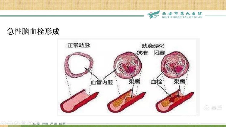 【特色技术】神经外科——球囊扩张及支架成形术治疗颅内动脉粥样硬化性狭窄（ICAS）