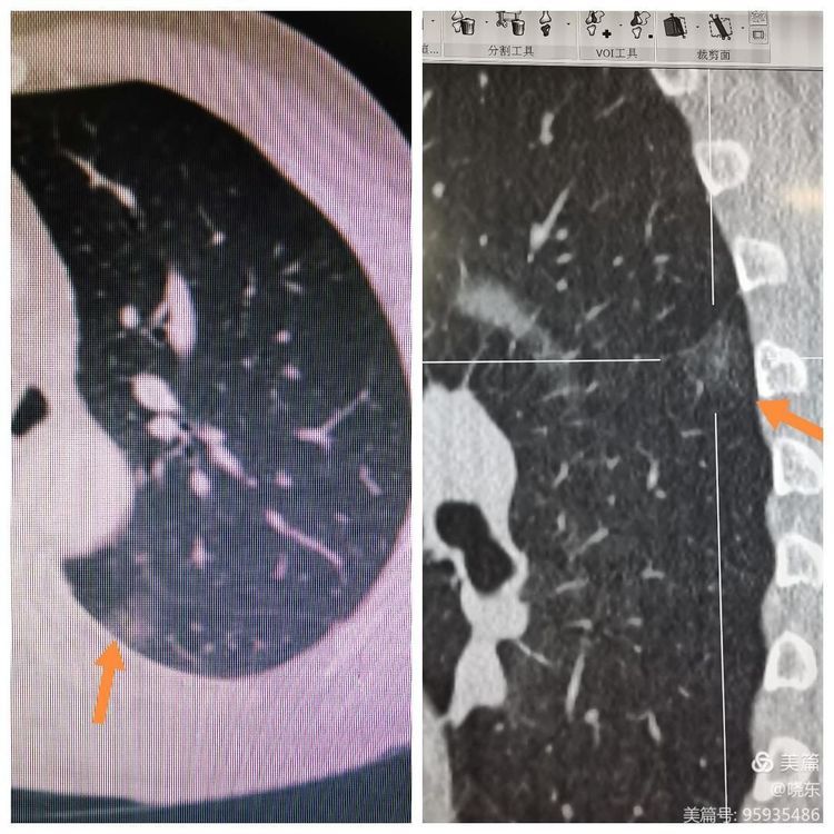 小结节不纠结,微创手术来解决 小结节不纠结,微创手术来解决