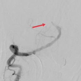 【医疗技术】神内卒中团队开通基底动脉1例 【医疗技术】神内卒中团队开通基底动脉1例