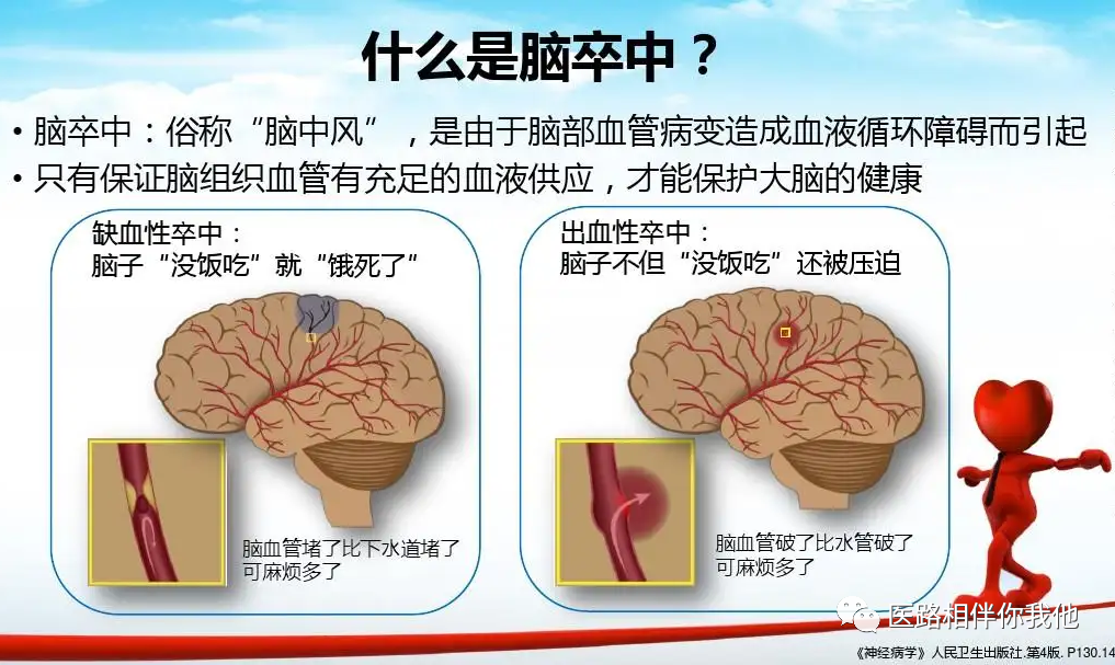 脑卒中是什么?严重吗?如何尽早发现? 脑卒中是什么?严重吗?如何尽早发现?