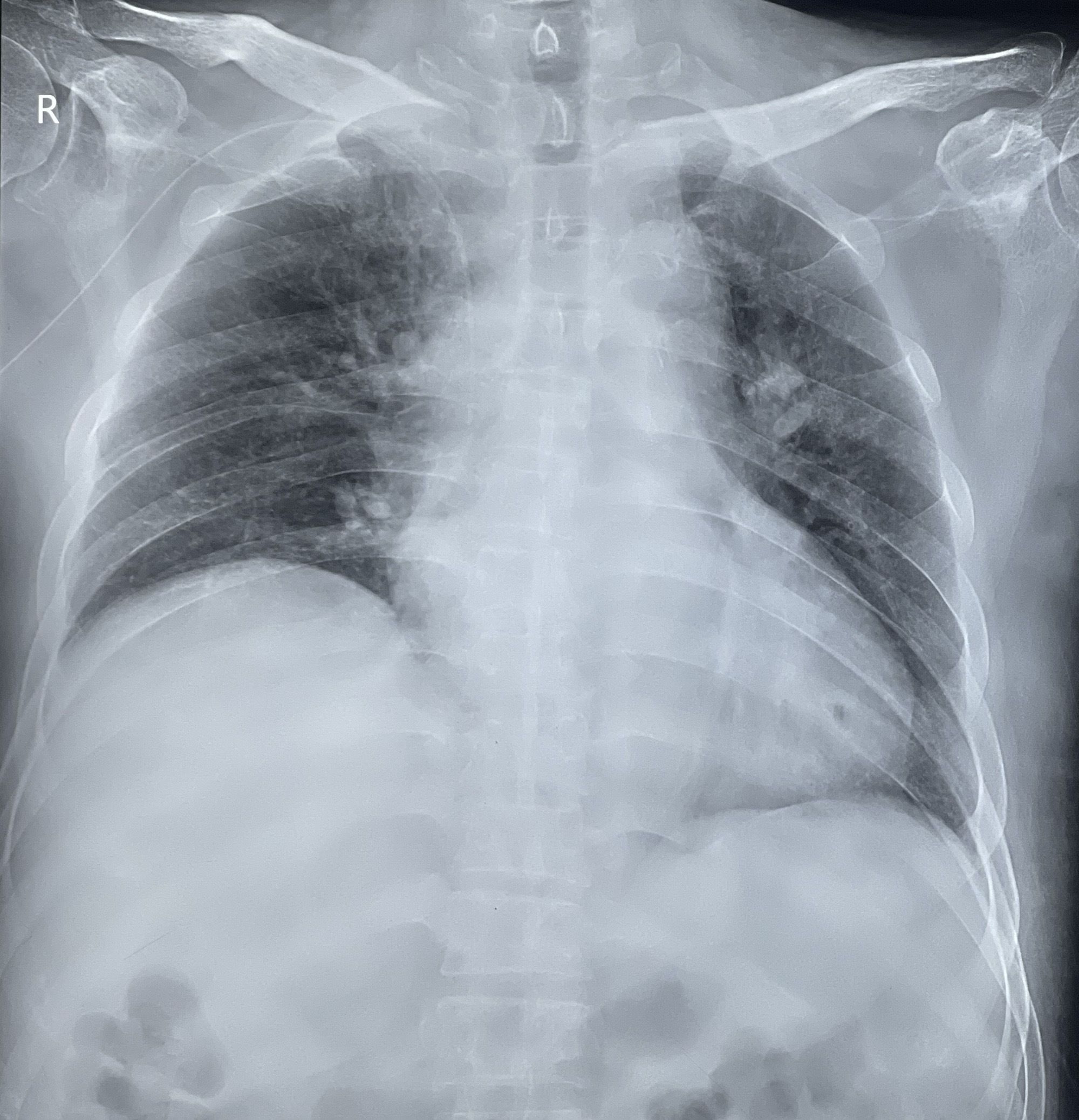 精准定位,精心守护——我院神经外科成功开展PICC腔内心电定位新技术 精准定位,精心守护——我院神经外科成功开展PICC腔内心电定位新技术