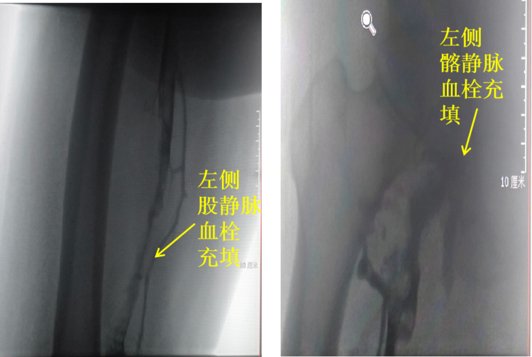 血管介入科开展“Angiojet机械祛栓术”救治一例Cockett综合征伴下肢深静脉血栓患者