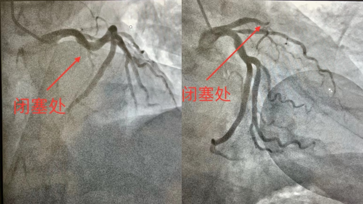 介入手术中心医护人员凝心聚力保障患者生命通道