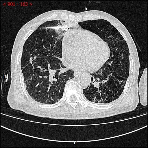 不开刀杀肿瘤：血管介入科开展首例CT引导下肺恶性肿瘤射频消融术