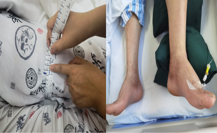 血管介入科开展“Angiojet机械祛栓术”救治一例Cockett综合征伴下肢深静脉血栓患者