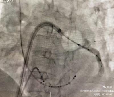 【特色技术】心血管病院——房颤冷冻消融+左心耳封堵“一站式”介入手术