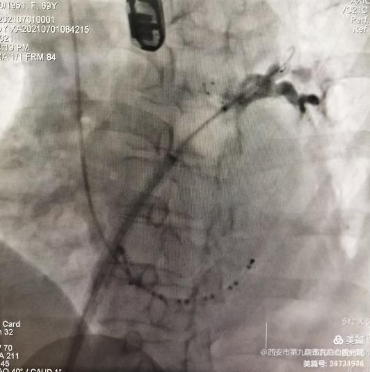 【特色技术】心血管病院——房颤冷冻消融+左心耳封堵“一站式”介入手术