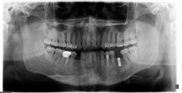 我院口腔科开展种植牙新技术 我院口腔科开展种植牙新技术