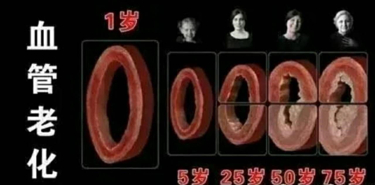 体检发现颈动脉斑块怎么办?10个要点要掌握 体检发现颈动脉斑块怎么办?10个要点要掌握