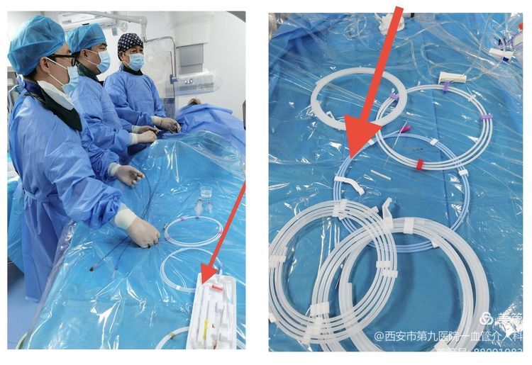 【血管介入科 】介入术中耗材保护的创新与临床应用