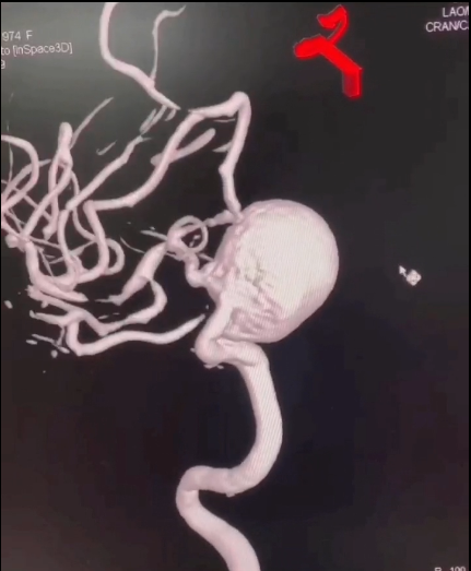 特色展示之九-血流导向装置在颅内复杂动脉瘤中的应用