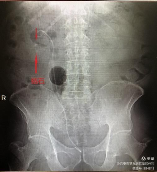 【泌尿外科】一次性电子输尿管软镜治疗上尿路结石
