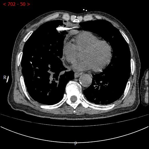 不开刀杀肿瘤：血管介入科开展首例CT引导下肺恶性肿瘤射频消融术
