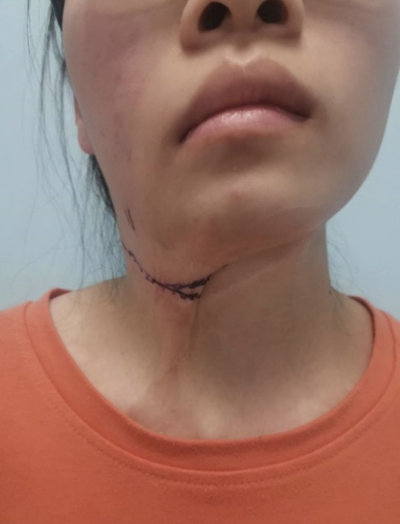 市九院烧伤整形美容科完成“预扩张肩胛皮瓣游离移植修复颈部瘢痕挛缩畸形”一例 市九院烧伤整形美容科完成“预扩张肩胛皮瓣游离移植修复颈部瘢痕挛缩畸形”一例
