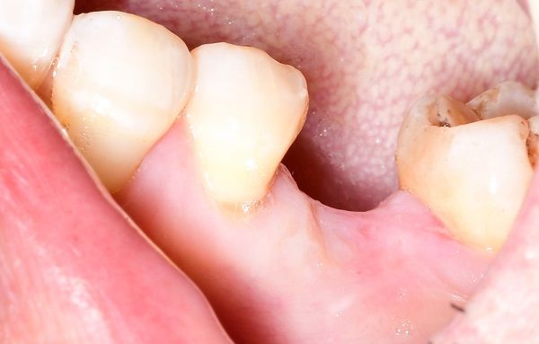 我院口腔科开展种植牙新技术 我院口腔科开展种植牙新技术