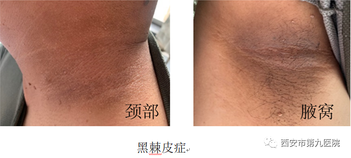 【健康科普】如何缓解2型糖尿病(一) 【健康科普】如何缓解2型糖尿病(一)