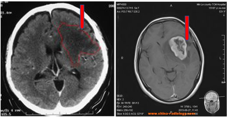 弥散张量成像在胶质瘤术中的应用