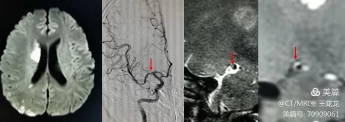 血管壁高分辨成像在头颈部血管斑块的危险性评估应用