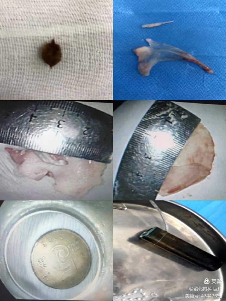 网篮在异物取出术中的应用