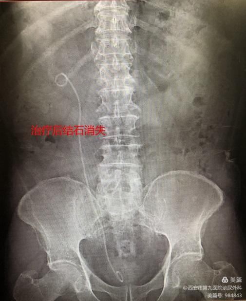 【泌尿外科】一次性电子输尿管软镜治疗上尿路结石