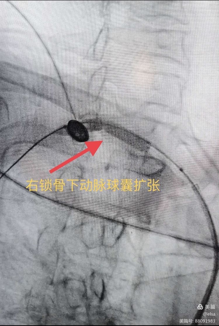 锁骨下动脉盗血症