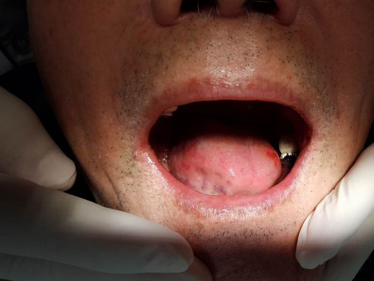 口腔科成功为一例高龄患者拆除不良修复体