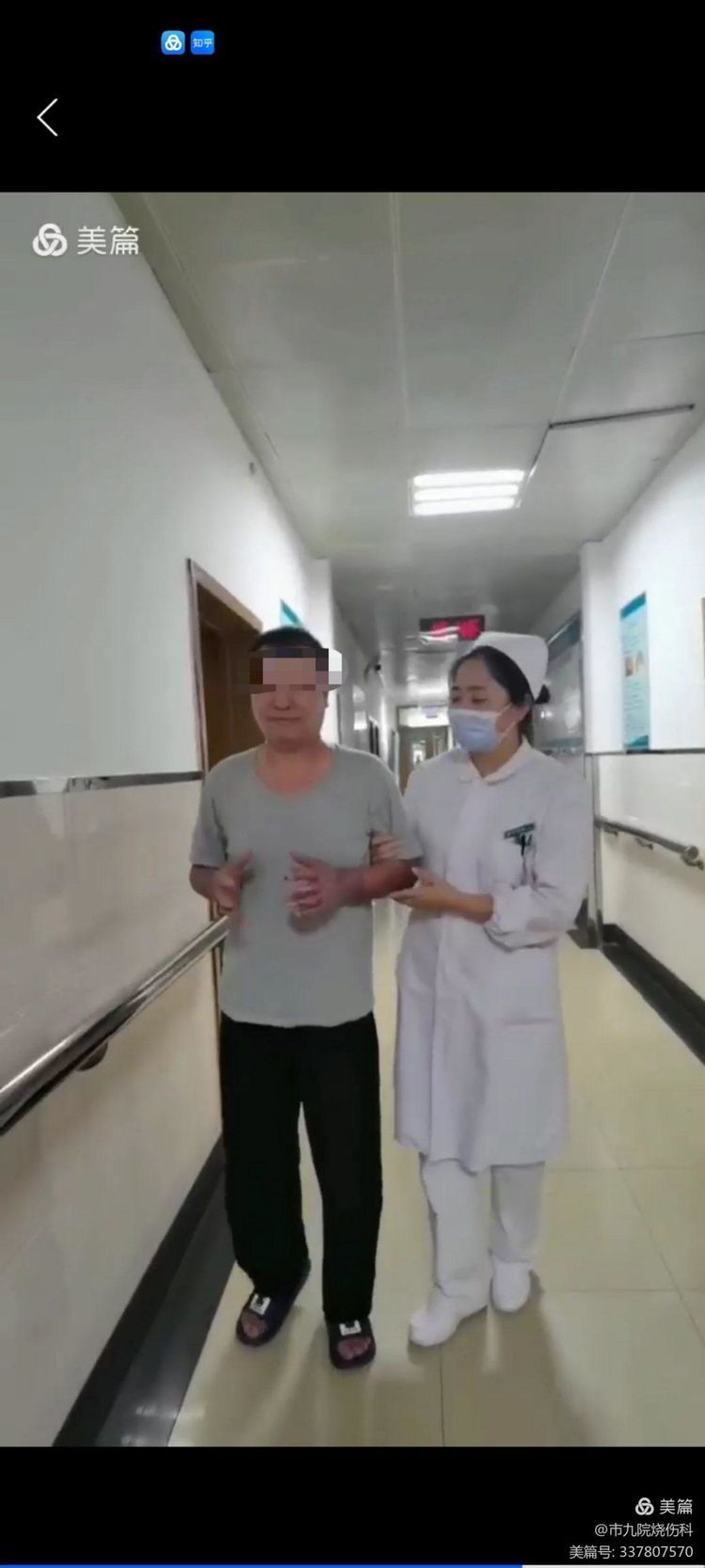 烧伤整形科治愈1例烧伤面积80％合并烧伤脓毒症重症患者