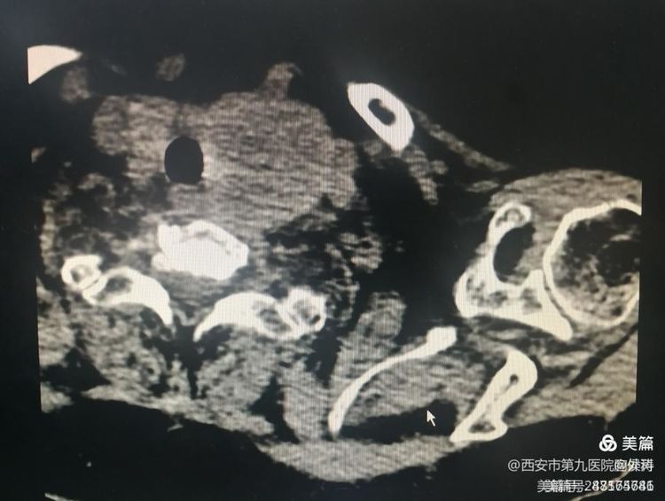微波消融在甲状腺结节治疗的应用