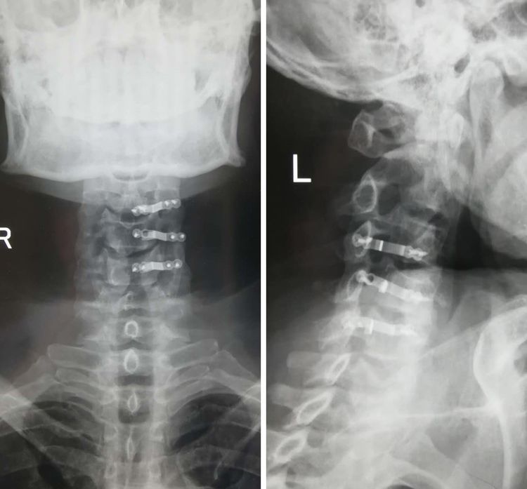 骨科救治一例颈髓损伤患者