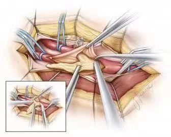 【科室动态】开通堵塞生命的河道
