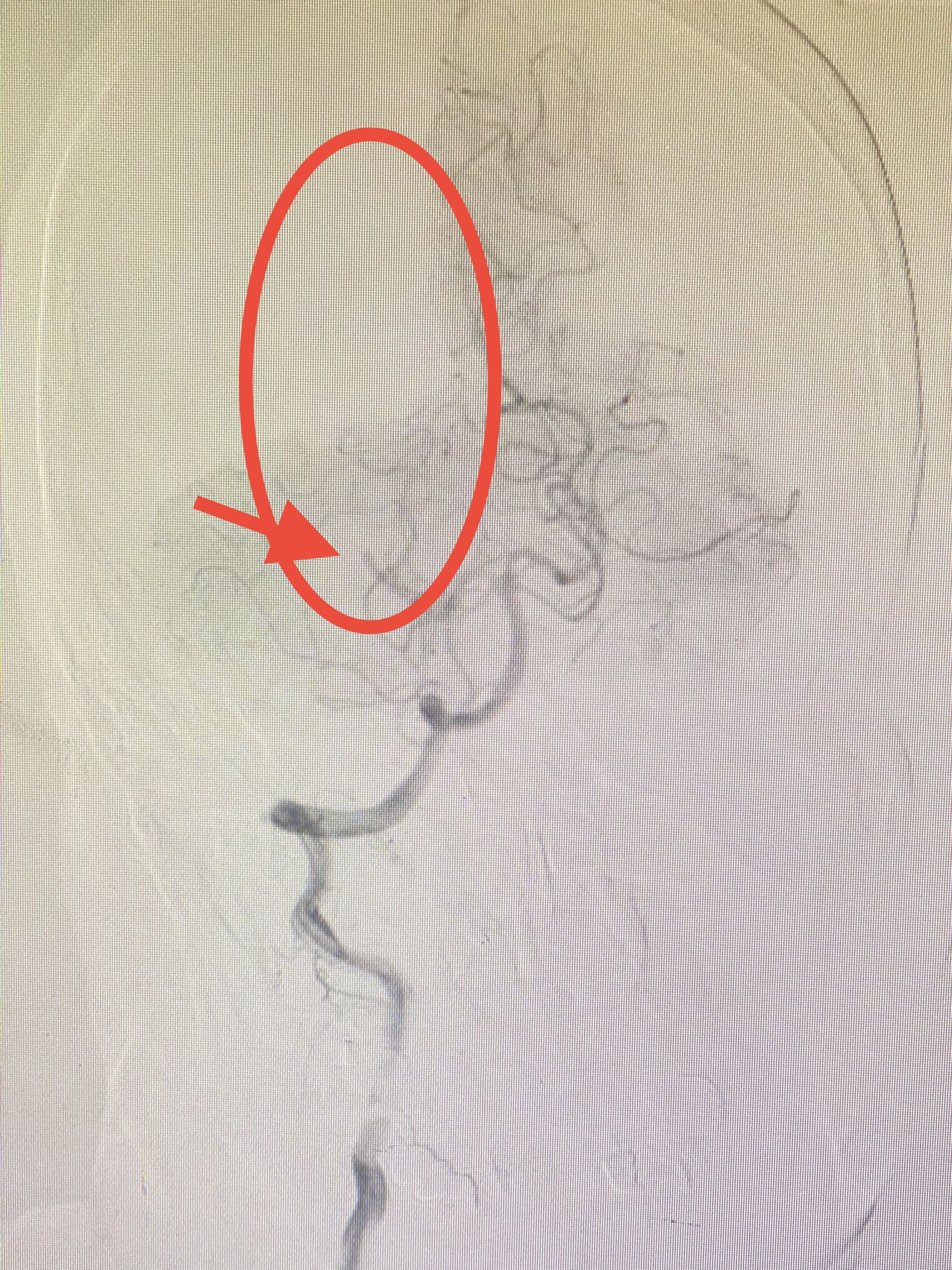 ADAPT技术快速开通颅内动脉栓塞一例 ADAPT技术快速开通颅内动脉栓塞一例