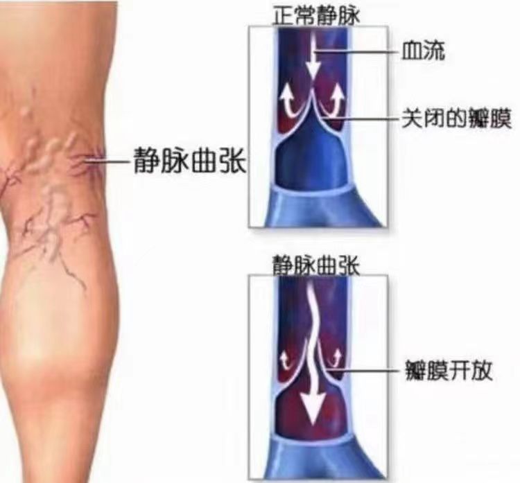 西安市第九医院血管介入科下肢静脉曲张门诊开诊了！