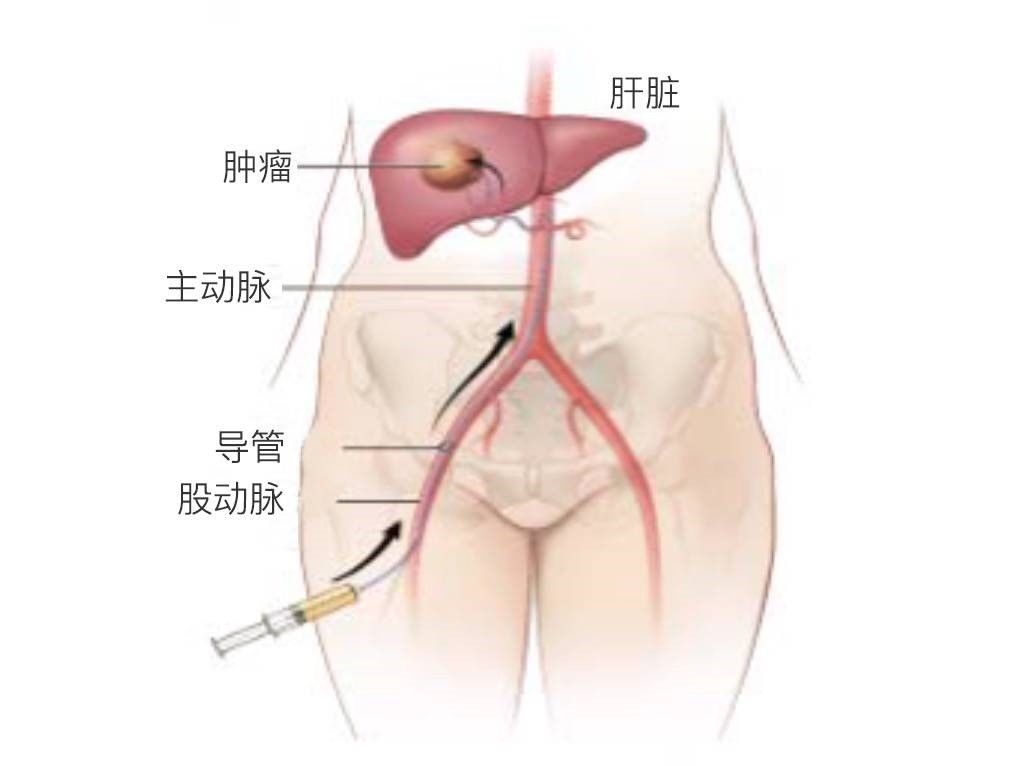 神奇的血管介入 神奇的血管介入
