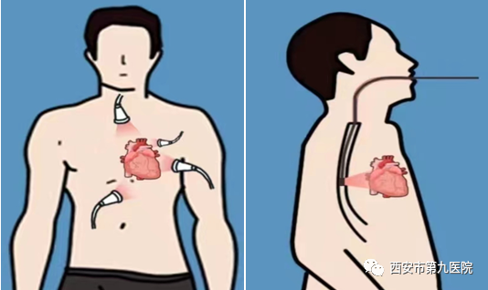 火眼金睛,一探究竟—经食道超声心动图 火眼金睛,一探究竟—经食道超声心动图