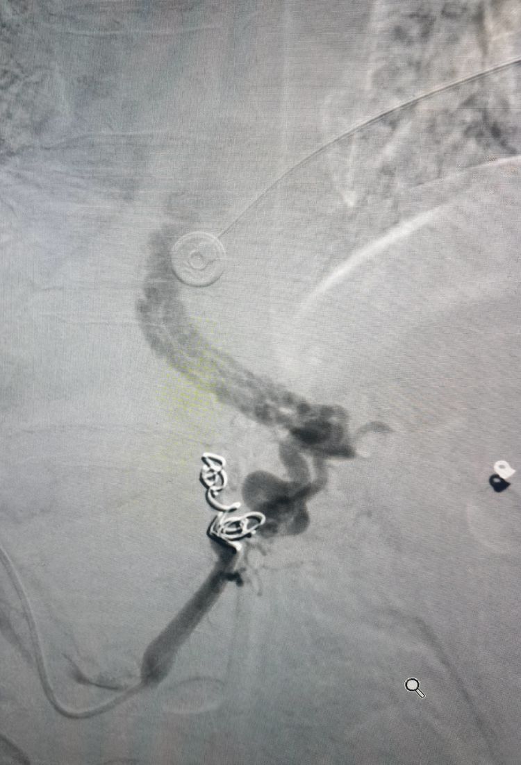 血管介入科救治一例肝硬化所致上消化道大出血患者 血管介入科救治一例肝硬化所致上消化道大出血患者