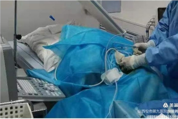 微波消融在甲状腺结节治疗的应用