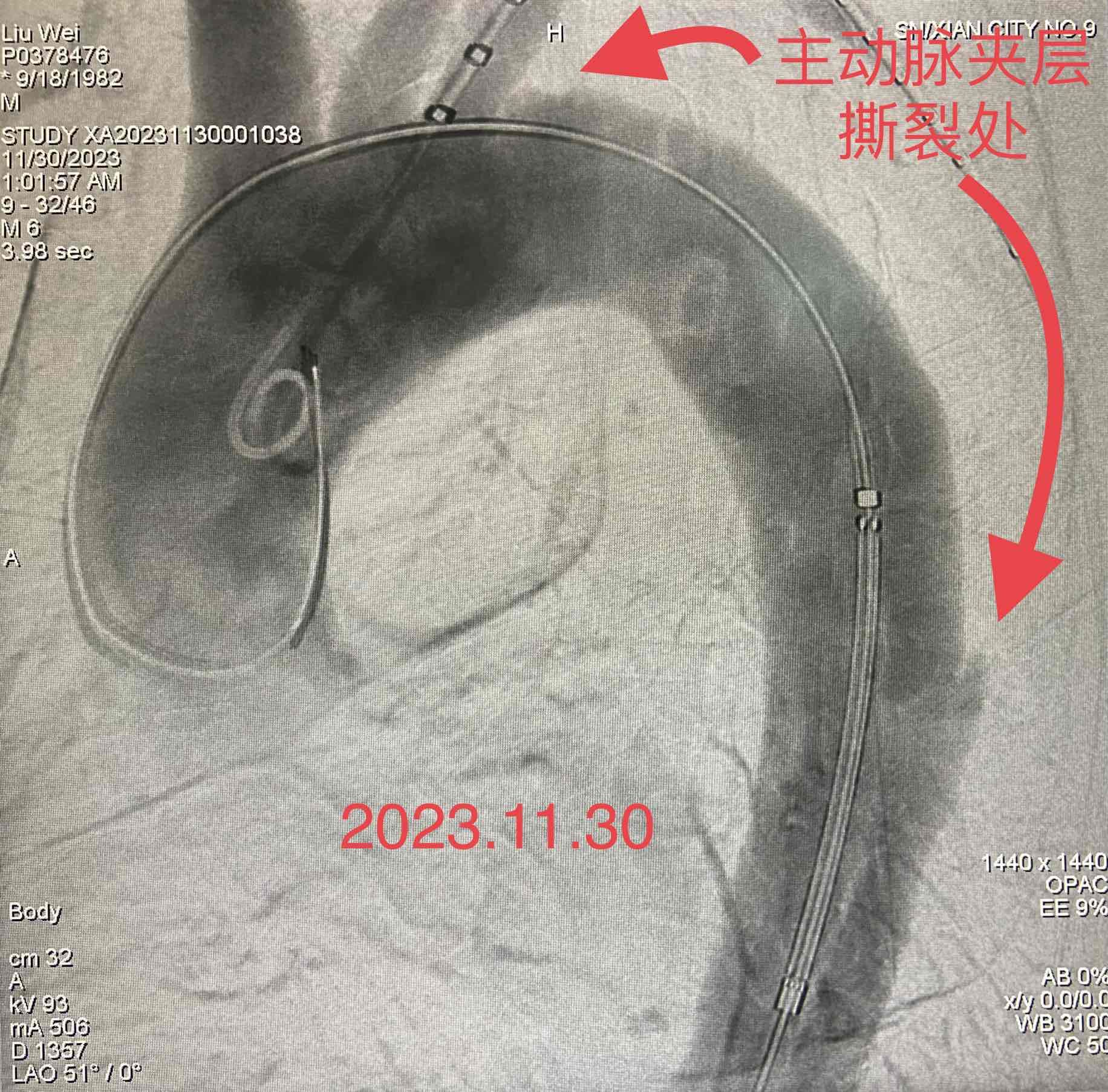 一例急性主动脉夹层患者就诊记