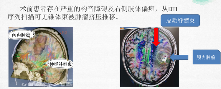 弥散张量成像在胶质瘤术中的应用