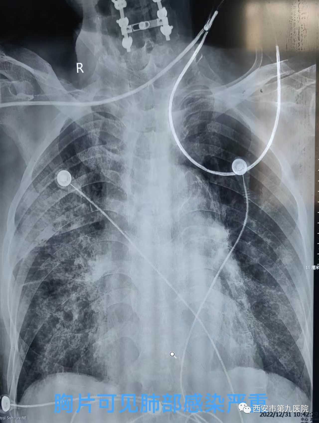 【科室动态】拯救“白肺”加“白脑”的八旬老人 【科室动态】拯救“白肺”加“白脑”的八旬老人